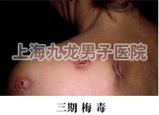 梅毒前期症状图片3