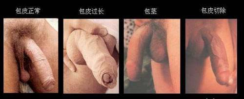 包皮过长手术费用