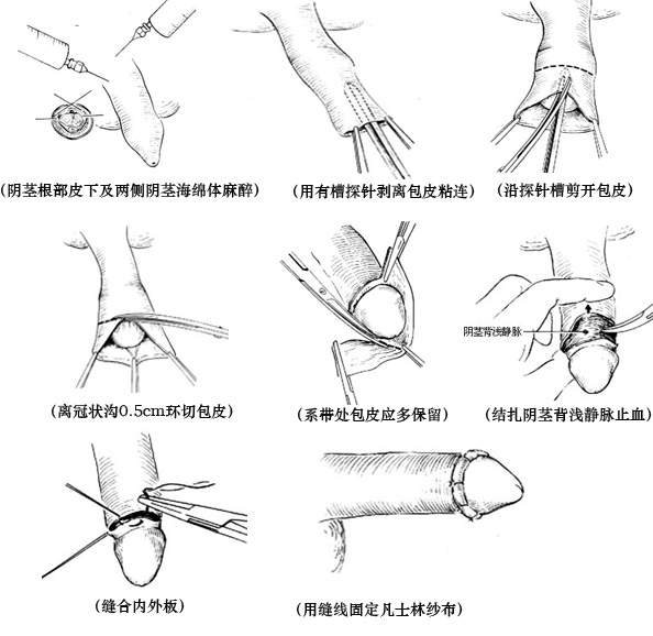 包皮包茎
